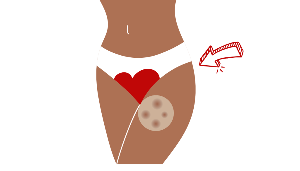 An illustration showing a period rash and skin irritation on the inner thigh caused by synthetic single-use pads.